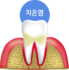 치은염