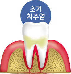 초기 치주염