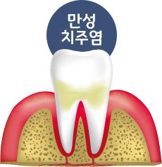 만성 치주염