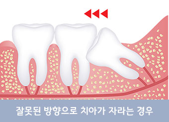 관리가 잘 안돼 충치가 생긴 경우