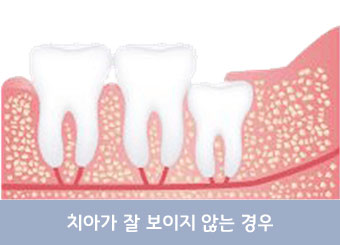 치아가 옆으로 누워 난 경우