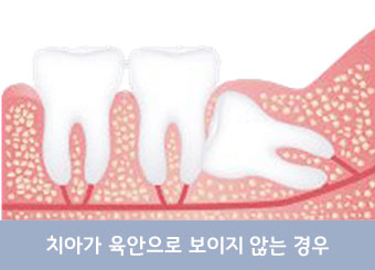 치아가 매복돼 낭종이 생긴 경우