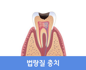 법랑질 충치