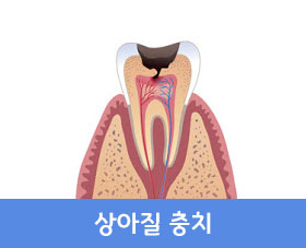 상아질 충치