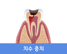 치수 충치