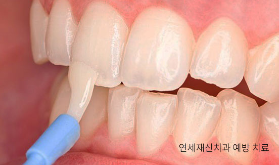 불소도포